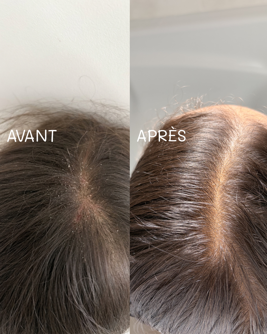 Shampoing anti-démangeaisons