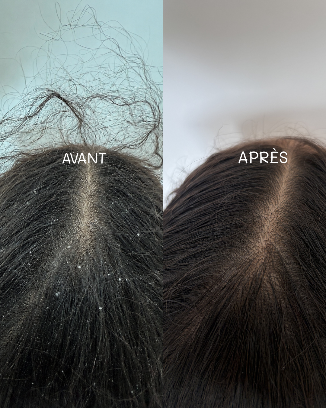 Shampoing anti-démangeaisons