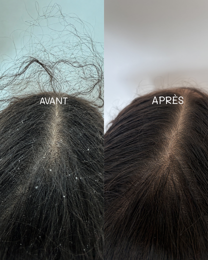 Shampoing anti-démangeaisons